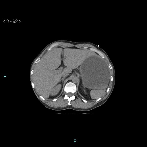 Boerhaave syndrome (Radiopaedia 27683-27897 Axial non-contrast 92).jpg