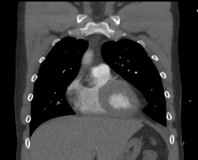 File:Boerhaave syndrome (Radiopaedia 39382-41660 C 28).png