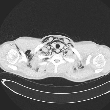 Boerhaave syndrome with mediastinal, axillary, neck and epidural free gas (Radiopaedia 41297-44115 Axial lung window 26).jpg