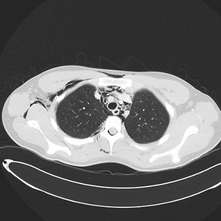 Boerhaave syndrome with mediastinal, axillary, neck and epidural free gas (Radiopaedia 41297-44115 Axial lung window 35).jpg