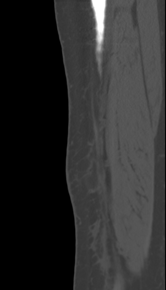 Bone metastasis - tibia (Radiopaedia 57665-64609 Sagittal bone window 27).jpg