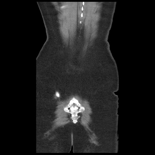Borderline mucinous tumor (ovary) (Radiopaedia 78228-90808 C 46).jpg
