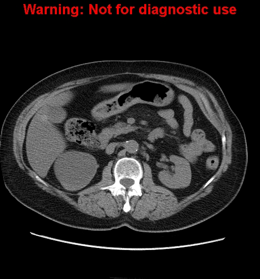 File:Bosniak renal cyst - type II (Radiopaedia 23404-23468 Axial non-contrast 14).jpg