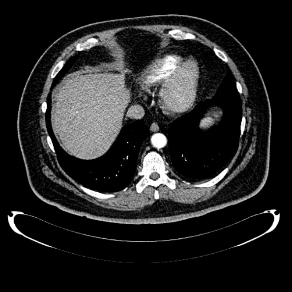 File:Bosniak renal cyst - type IV (Radiopaedia 24244-24518 B 22).jpg