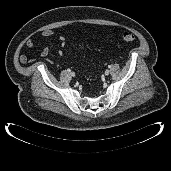 Bosniak renal cyst - type IV (Radiopaedia 24244-24518 C 315).jpg