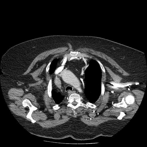 Bovine aortic arch - right internal mammary vein drains into the superior vena cava (Radiopaedia 63296-71875 A 27).jpg