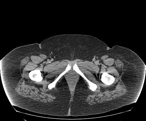 Bowel and splenic infarcts in acute lymphocytic leukemia (Radiopaedia 61055-68913 A 130).jpg