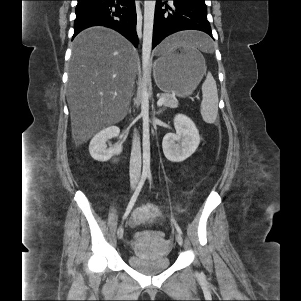 File:Bowel and splenic infarcts in acute lymphocytic leukemia (Radiopaedia 61055-68915 B 36).jpg