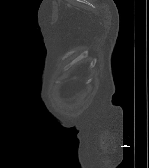 Bowel ischemia secondary to SMA occlusion with extensive portomesenteric venous gas (Radiopaedia 54656-60871 Sagittal bone window 3).jpg