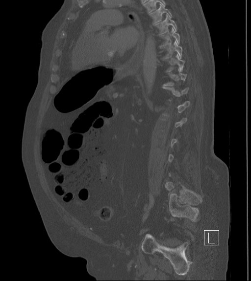Bowel ischemia secondary to SMA occlusion with extensive portomesenteric venous gas (Radiopaedia 54656-60871 Sagittal bone window 43).jpg