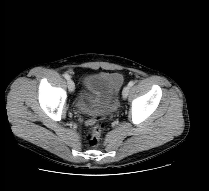 Bowel obstruction from colon carcinoma (Radiopaedia 22995-23028 A 76).jpg
