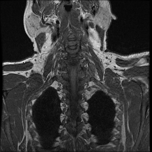 File:Brachial plexus neurofibroma (Radiopaedia 28030-28291 Coronal T1 3).png
