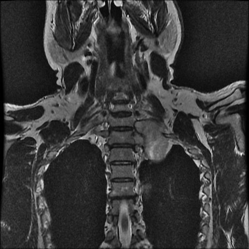 File:Brachial plexus neurofibroma (Radiopaedia 28030-28291 Coronal T2 4).png