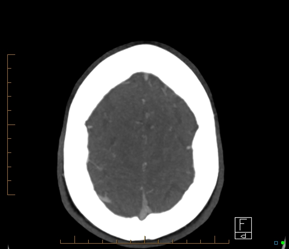 Brachiocephalic trunk stenosis (Radiopaedia 87242-103519 A 9).jpg