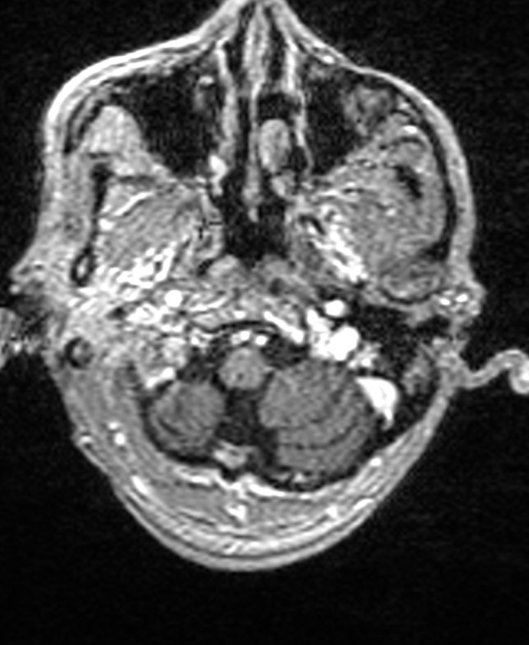 Brain abscess with dual rim sign (Radiopaedia 87566-103938 Axial T1 C+ 27).jpg