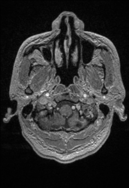 Brain abscess with ventriculitis (Radiopaedia 85703-101495 Axial T1 C+ 25).jpg