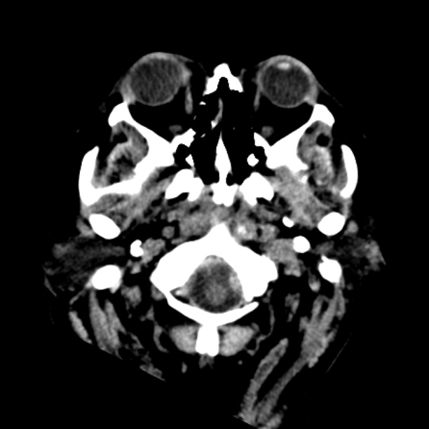 Brain cortical laminar necrosis (Radiopaedia 25822-25971 Axial non-contrast 1).jpg