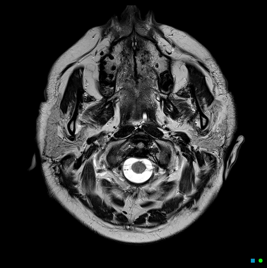 File:Brain death on MRI and CT angiography (Radiopaedia 42560-45689 Axial T2 2).jpg