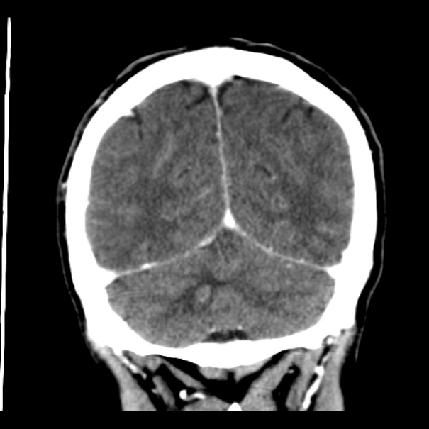 Brain metastases from lung cancer (Radiopaedia 24480-24781 Coronal C+ delayed 50).jpg