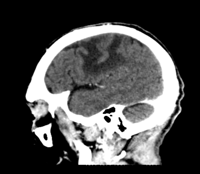 Brain metastases from lung cancer (Radiopaedia 27849-28092 Sagittal C+ delayed 14).jpg
