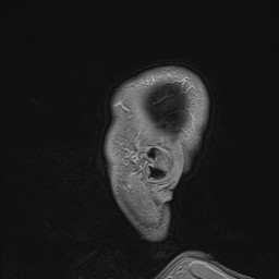Brain metastasis (Radiopaedia 42617-45761 Sagittal T1 C+ 4).jpg