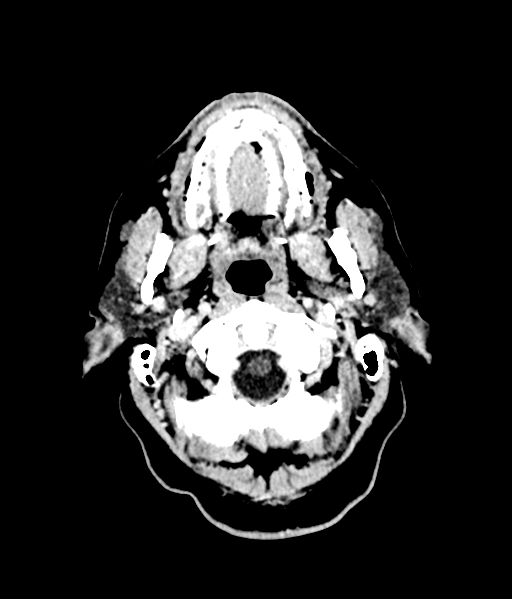 File:Brain metastasis (large cystic mass) (Radiopaedia 47497-52106 Axial C+ 9).png