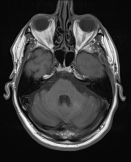 File:Brain metastasis (large cystic mass) (Radiopaedia 47497-52107 Axial T1 7).png