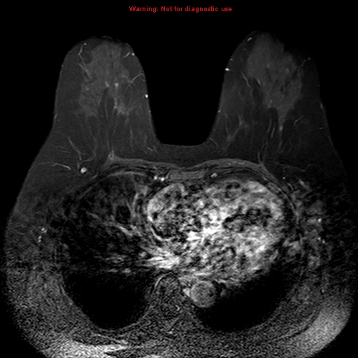 File:Breast carcinoma (multicentric multifocal in mammary Paget disease) (Radiopaedia 50966-56512 Axial T1 C+ fat sat 6).jpg