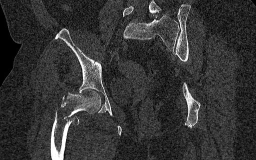 File:Breast carcinoma with pathological hip fracture (Radiopaedia 60314-67993 Coronal bone window 76).jpg