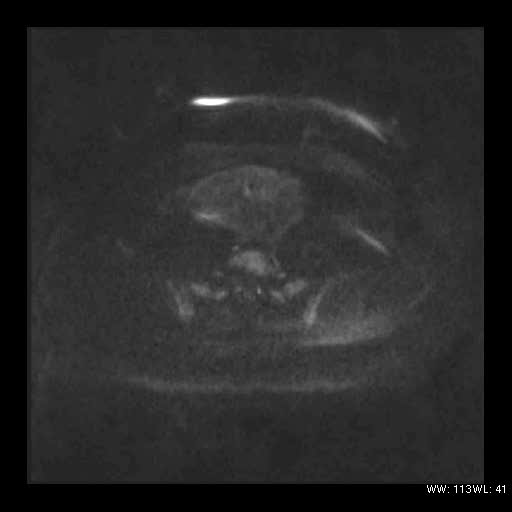 File:Broad ligament fibroid (Radiopaedia 49135-54241 Axial DWI 11).jpg