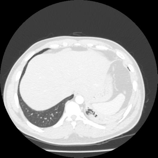 Bronchial carcinoid (Radiopaedia 80013-93291 Axial lung window 111).jpg