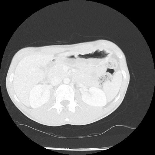Bronchial carcinoid tumor causing right lower lobe collapse (Radiopaedia 83495-98594 Axial lung window 61).jpg