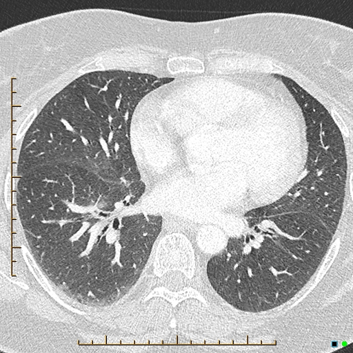 Bronchial diverticula (Radiopaedia 79512-92676 Axial lung window 115).jpg