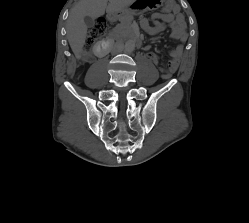 Bronchiectasis in Crohn disease (Radiopaedia 60311-67977 Coronal bone window 42).jpg