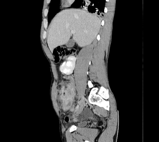 Bronchiectasis in Crohn disease (Radiopaedia 60311-67977 D 37).jpg