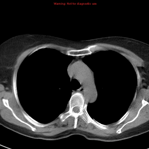 File:Bronchoalveolar carcinoma (BAC) (Radiopaedia 13436-13392 Axial non-contrast 17).jpg