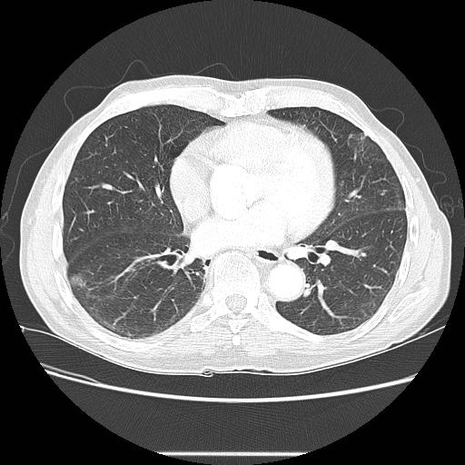 Bronchocele (Radiopaedia 17097-16795 Axial lung window 72).jpg