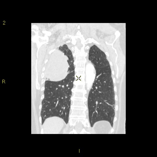 File:Bronchogenic carcinoma as an incidental finding (Radiopaedia 16453-16130 Coronal lung window 37).jpg