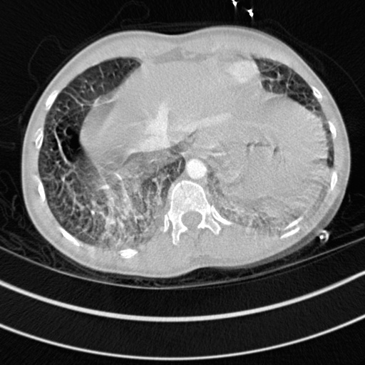 File:Bronchogenic cyst (Radiopaedia 77801-90071 Axial lung window 75).jpg