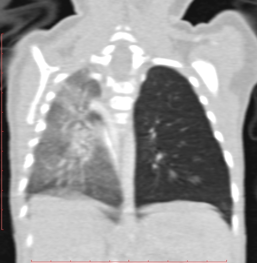 File:Bronchogenic cyst (Radiopaedia 78599-91409 Coronal lung window 156).jpg