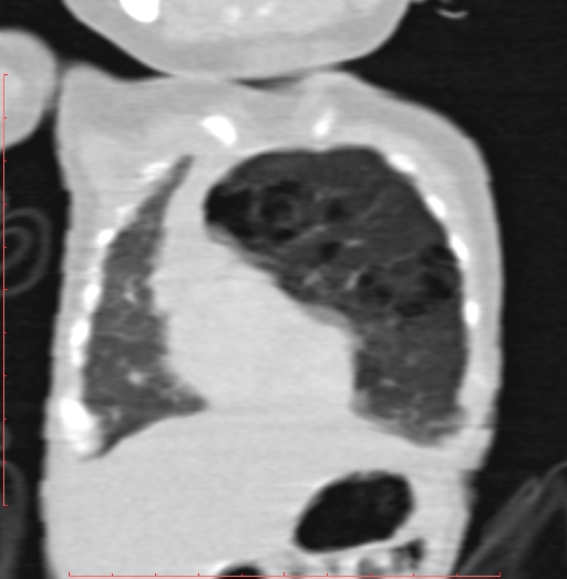 File:Bronchogenic cyst (Radiopaedia 78599-91409 Coronal lung window 56).jpg