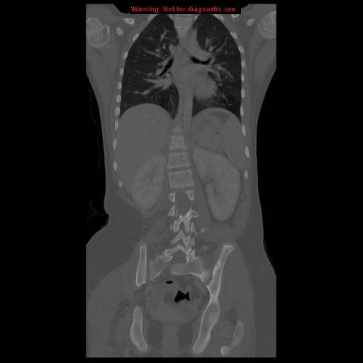 File:Brown tumor (Radiopaedia 12318-12596 D 42).jpg
