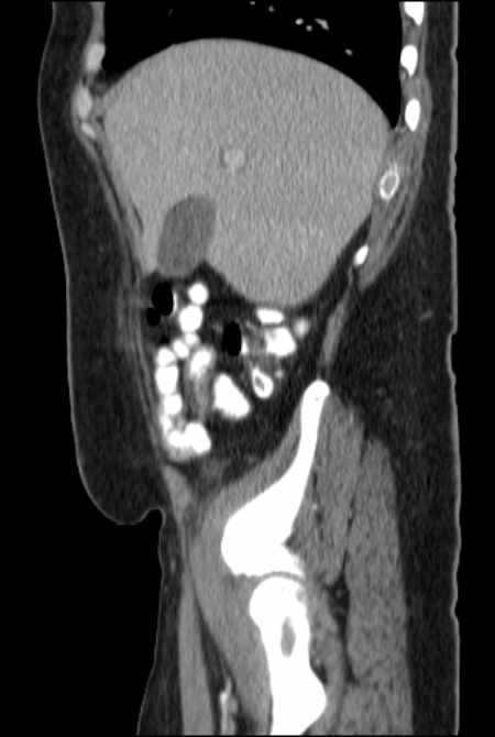 Brown tumors compressing the spinal cord (Radiopaedia 68442-77988 F 14).jpg