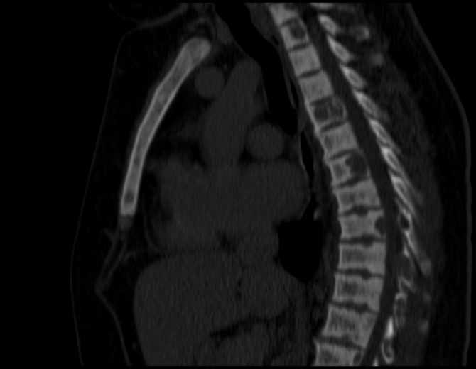 Brown tumors compressing the spinal cord (Radiopaedia 68442-77988 Sagittal bone window 29).jpg