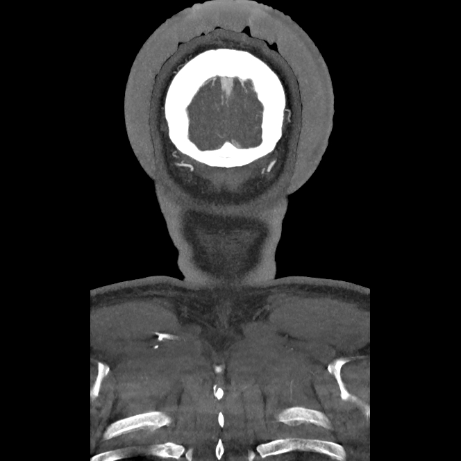 Buccal fat pad arteriovenous malformation (Radiopaedia 70936-81144 B 57).jpg