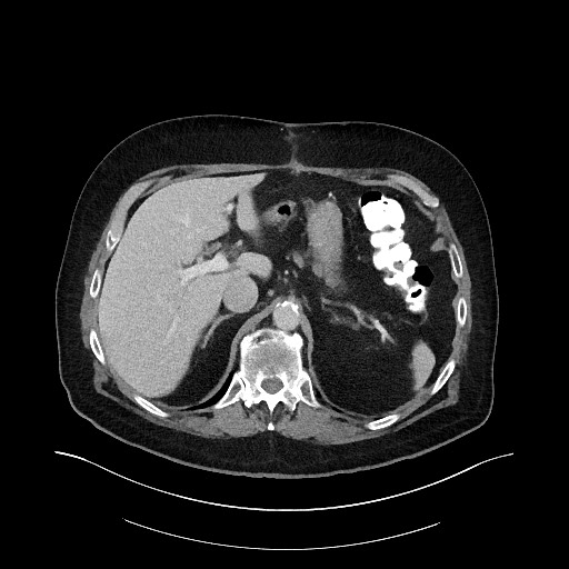 Buried bumper syndrome - gastrostomy tube (Radiopaedia 63843-72575 A 12).jpg