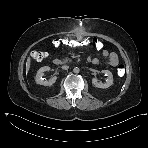 File:Buried bumper syndrome - gastrostomy tube (Radiopaedia 63843-72577 Axial Inject 42).jpg
