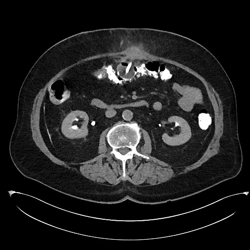 Buried bumper syndrome - gastrostomy tube (Radiopaedia 63843-72577 Axial Inject 48).jpg