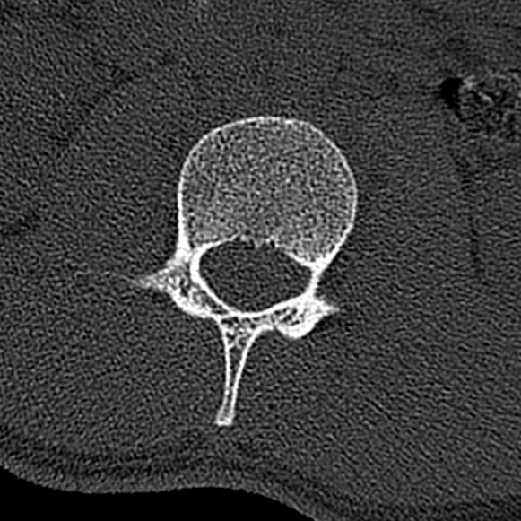 Burst fracture (Radiopaedia 53373-59357 Axial bone window 24).jpg