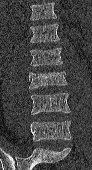 Burst fracture (Radiopaedia 53373-59357 Coronal bone window 23).jpg